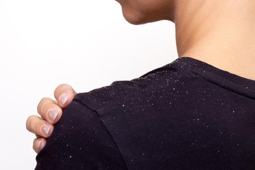 Jovem mulher de camiseta preta segurando o ombro, traços de caspa na camiseta.